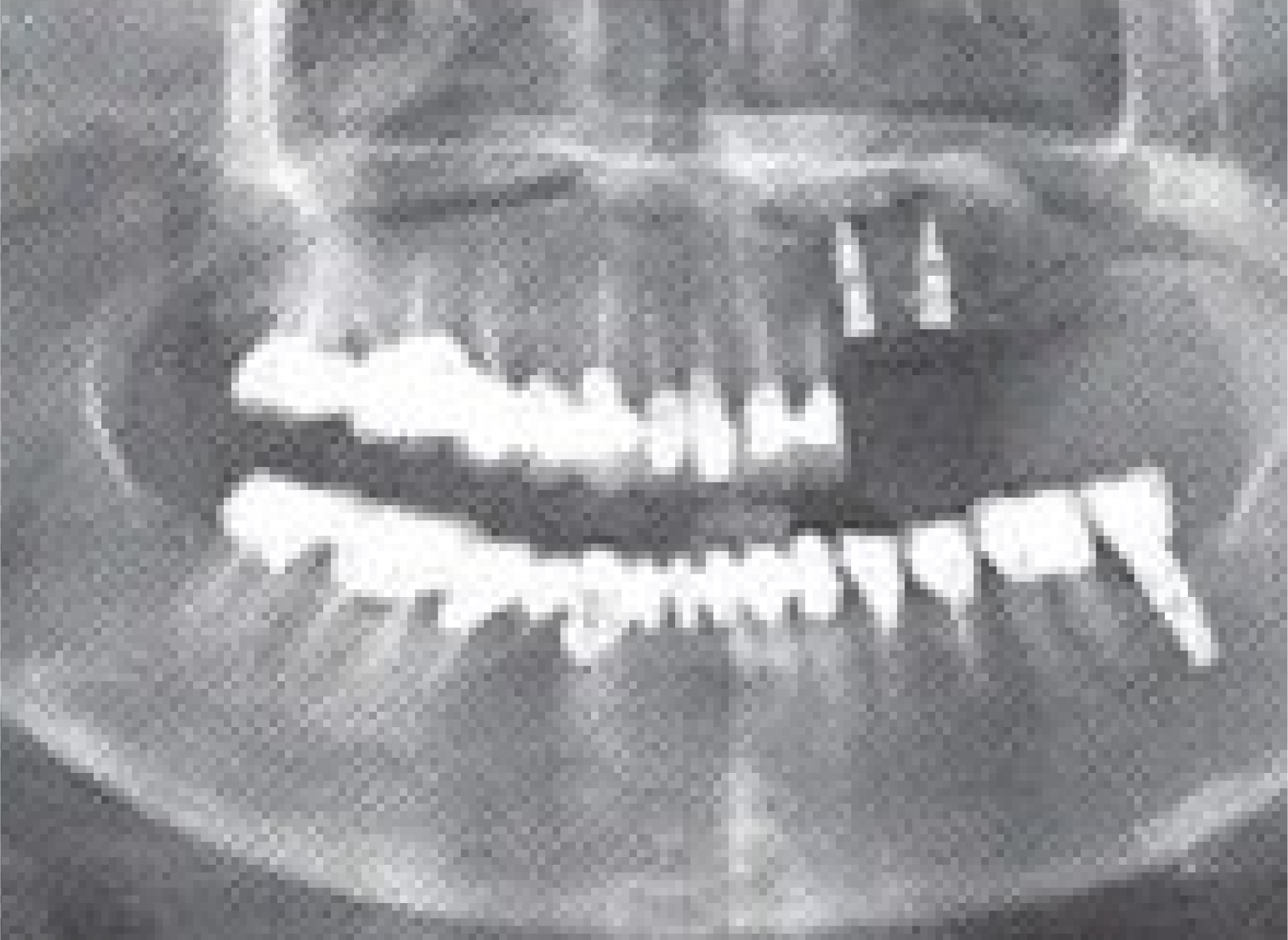 SorBone Syringe после установки имплантов.png