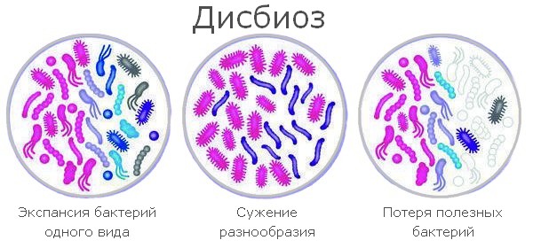 Дисбаланс микрофлоры кишечника