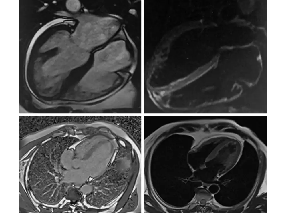 T1 и T2 режимы МРТ сердца