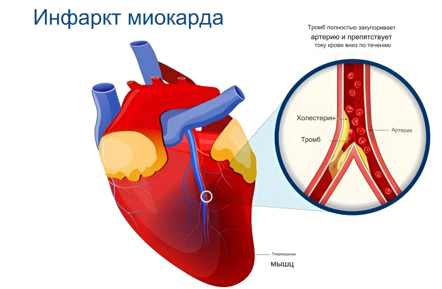 Операция аортокоронарного шунтирования (АКШ)