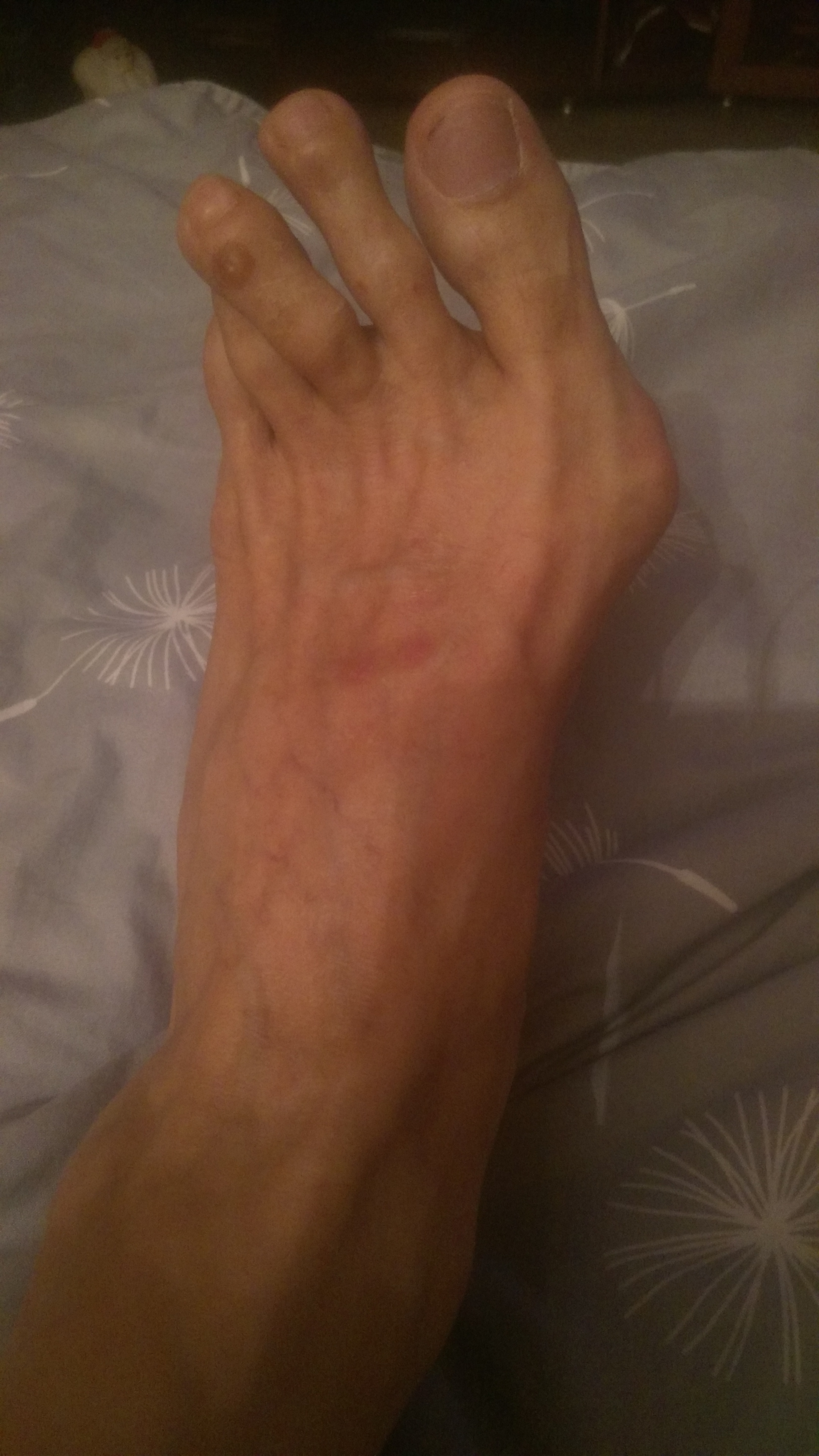 Молоткообразная деформация пальцев ног, причины и лечение