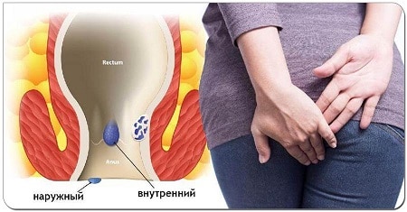Какие проявления бывают у геморроя