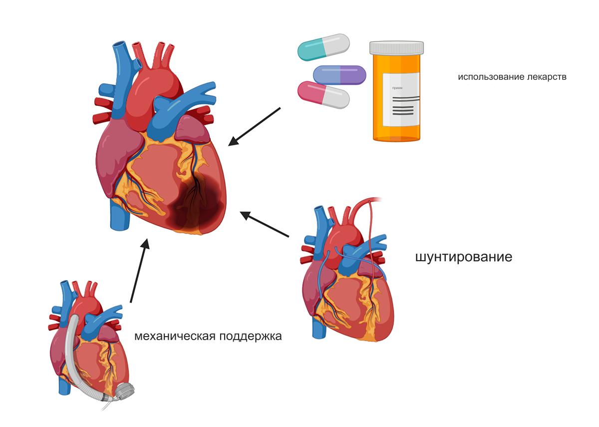 Лечение инфаркта миокарда