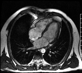 Кинорежим МРТ сердца