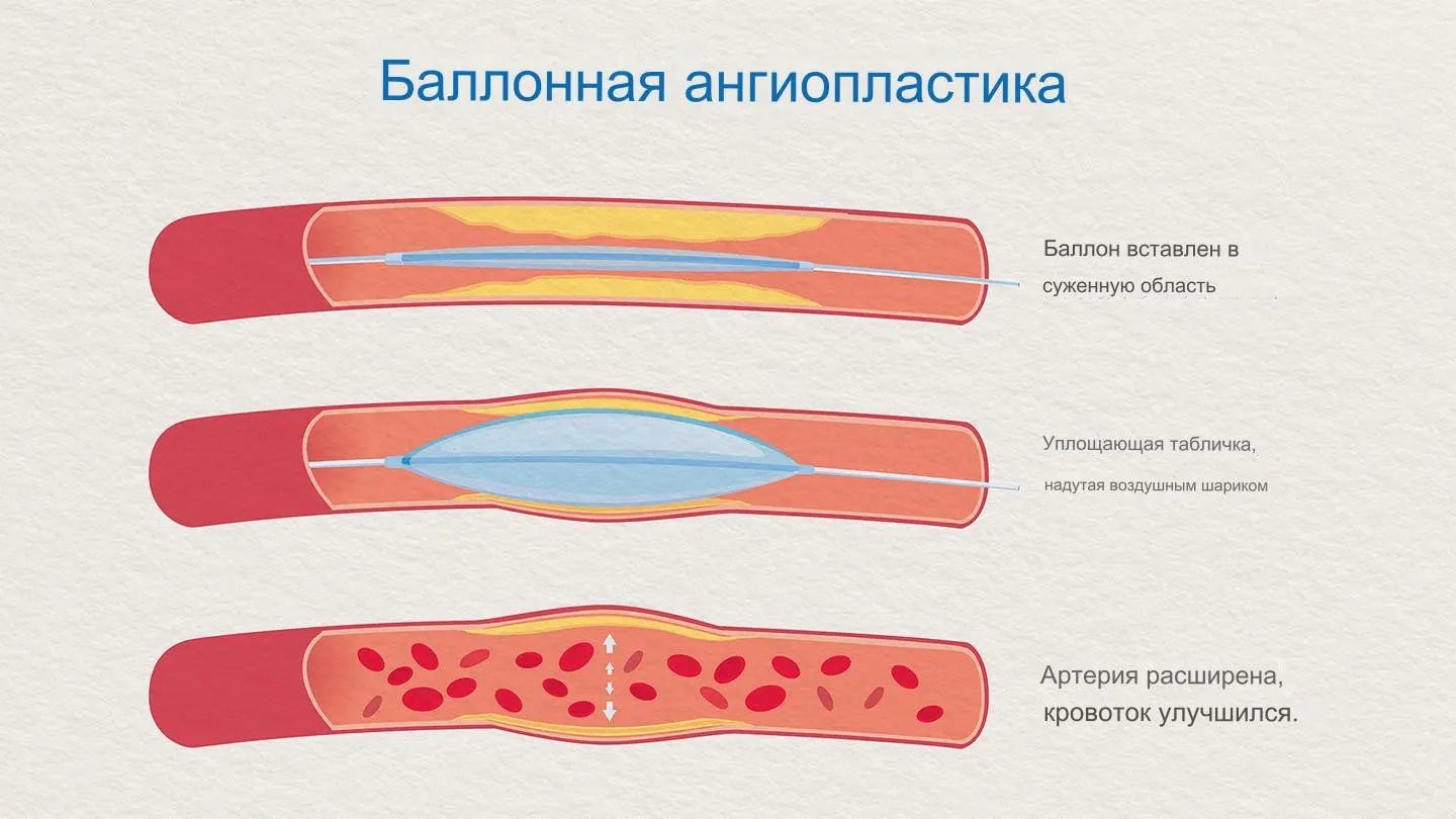 Ангиопластика