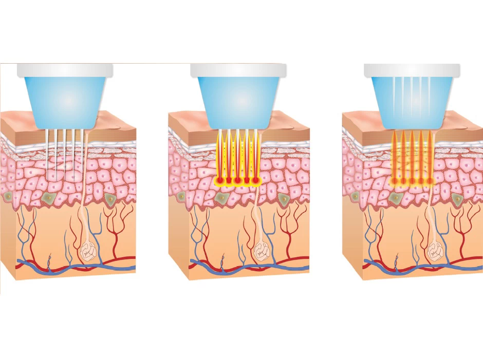Микроигольчатый RF-лифтинг-1.webp