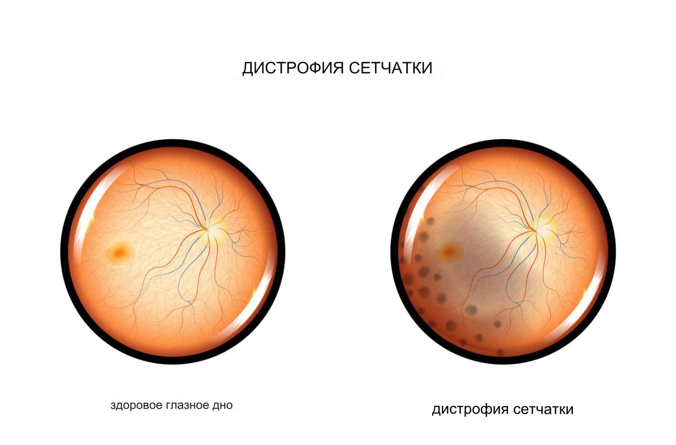 дистрофия сетчатки