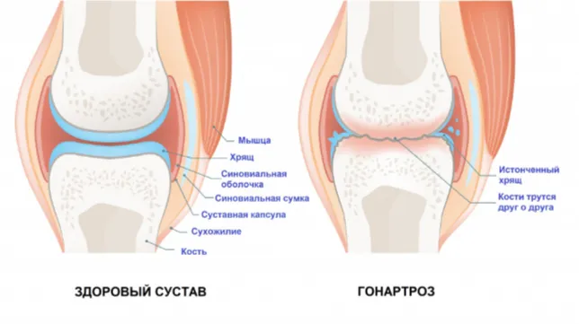 Как выглядит гонартроз