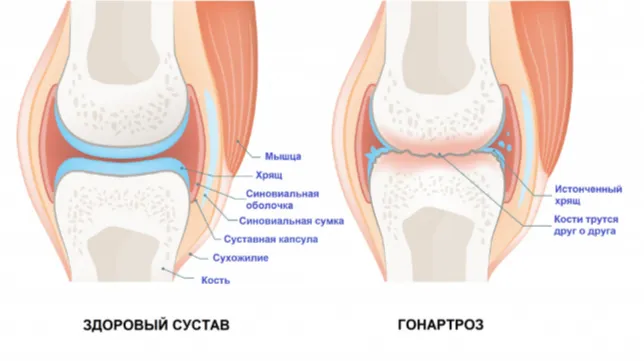 Гонартроз коленного сустава - симптомы, степени, лечение, операция в Москве.