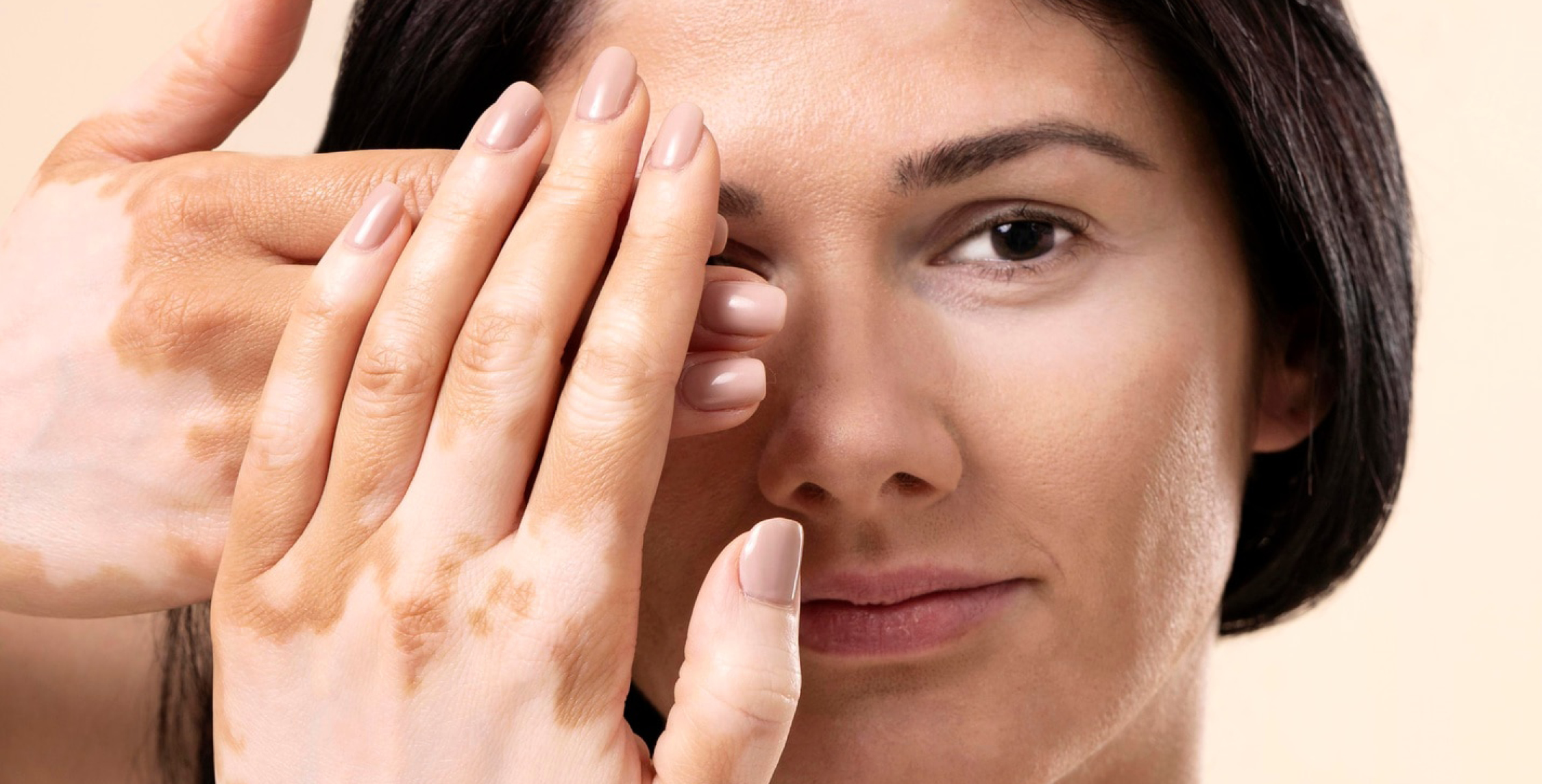 Vitiligo-biomarkers_1000x500 Vitiligo-biomarkers_1000x500.jpg