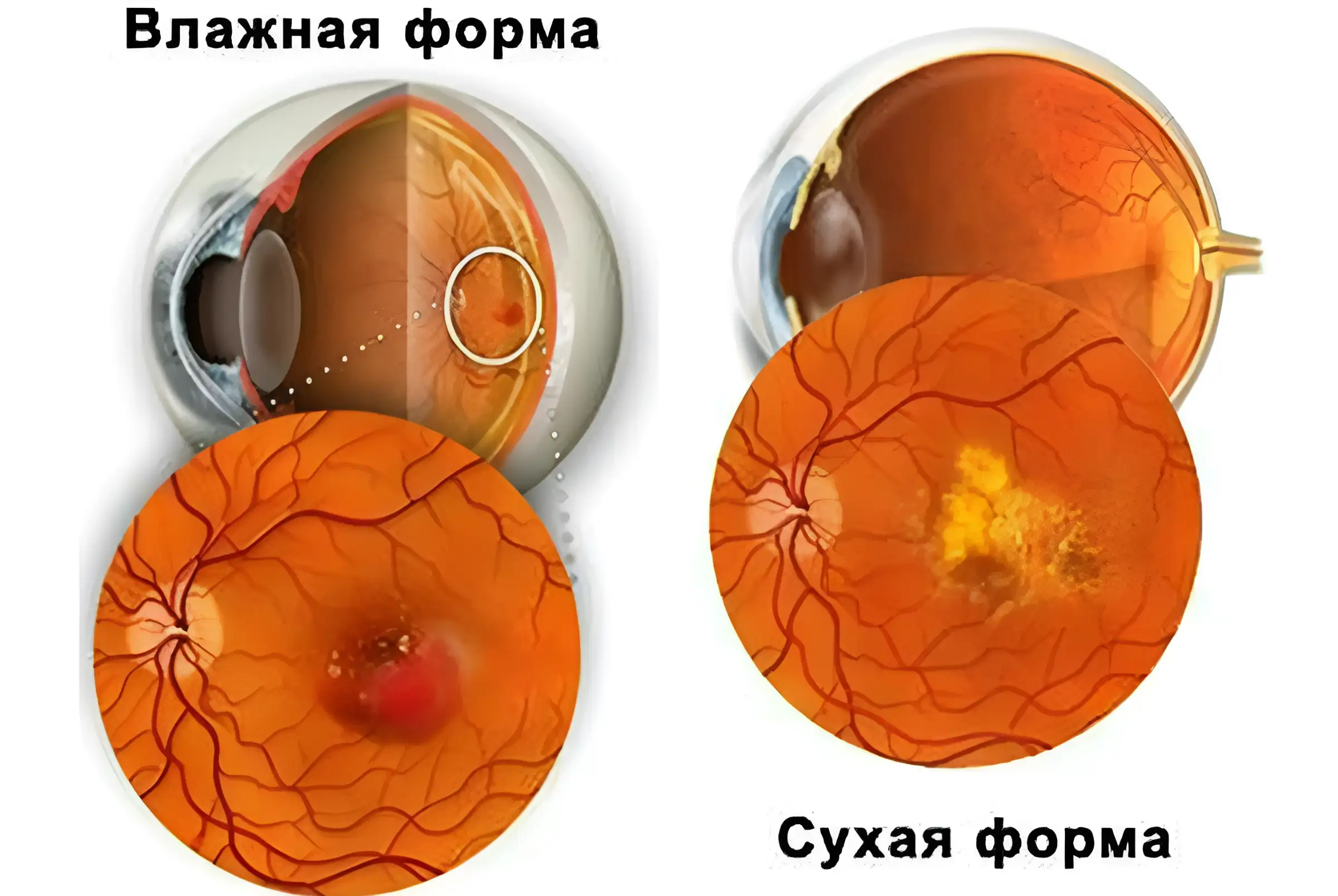 Макулярная дистрофия сетчатки глаза. Макулодистрофия, макулярная дегенерация. Возрастная макулярная дегенерация сетчатки. Сухая и влажная форма возрастной макулярной дегенерации сетчатки.