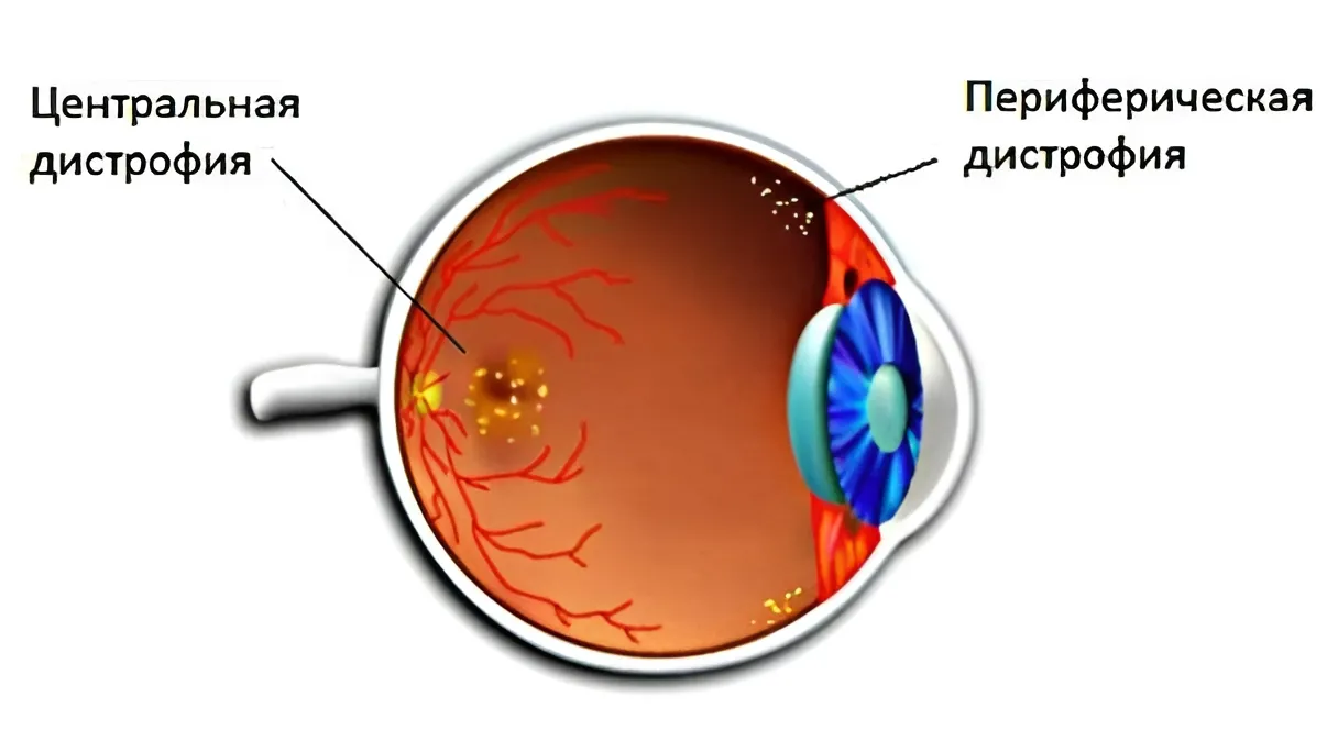 Сифилитический хориоретинит. Дистрофия сетчатки мкб. Дистрофия сетчатки мкб. Решетчатая дистрофия сетчатки. Мкб колобома хориоидеи.