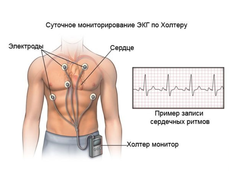 Схема размещения электродов для холтер‑мониторирования