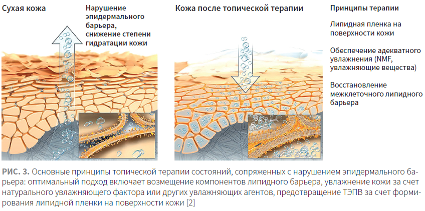 Эпидермальный барьер кожи. Эпидермальные липиды. Кожа с нарушенным эпидермальным барьером. Нарушение гидролипидного барьера кожи.