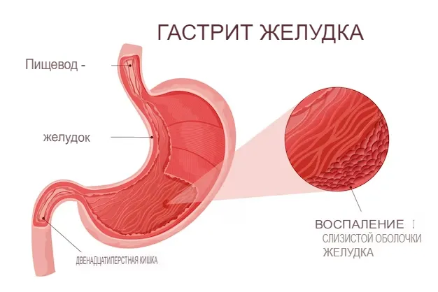 плохие привычки и гастрит