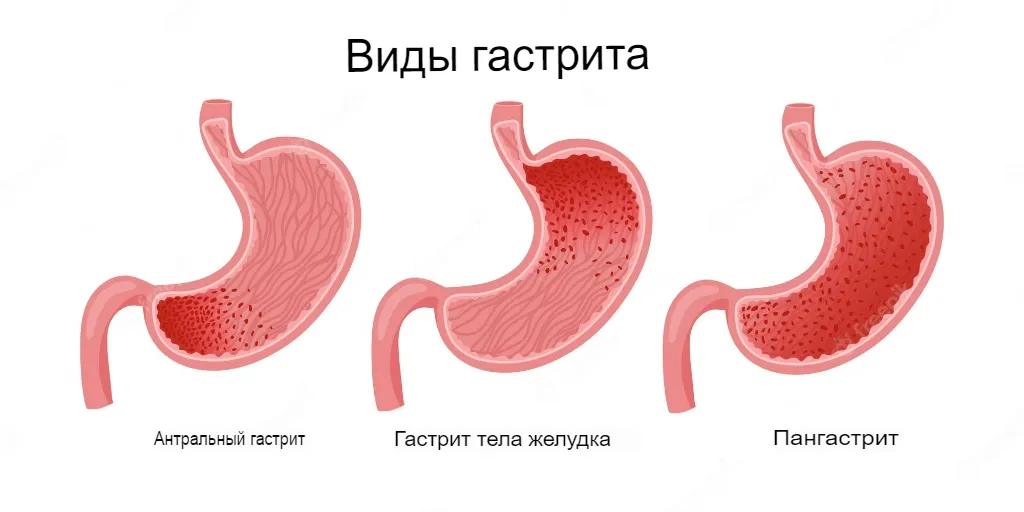 Гастрит хронический