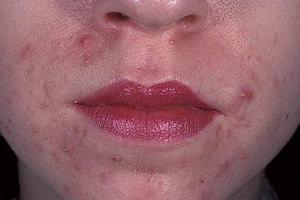 allergicheskii-dermatit-na-lice.jpg
