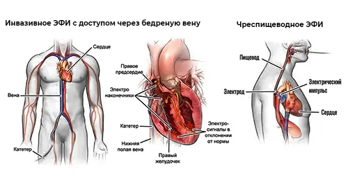 EFI-serdca