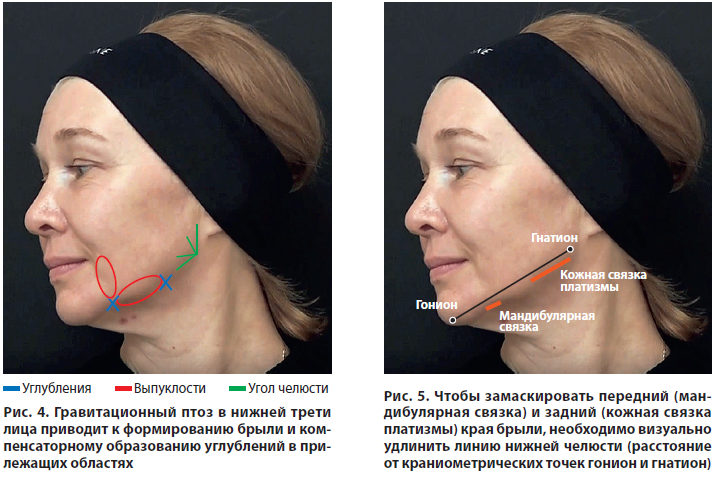 Несъемный аппарат для расширения верхней челюсти (аппарат Марко Роса)