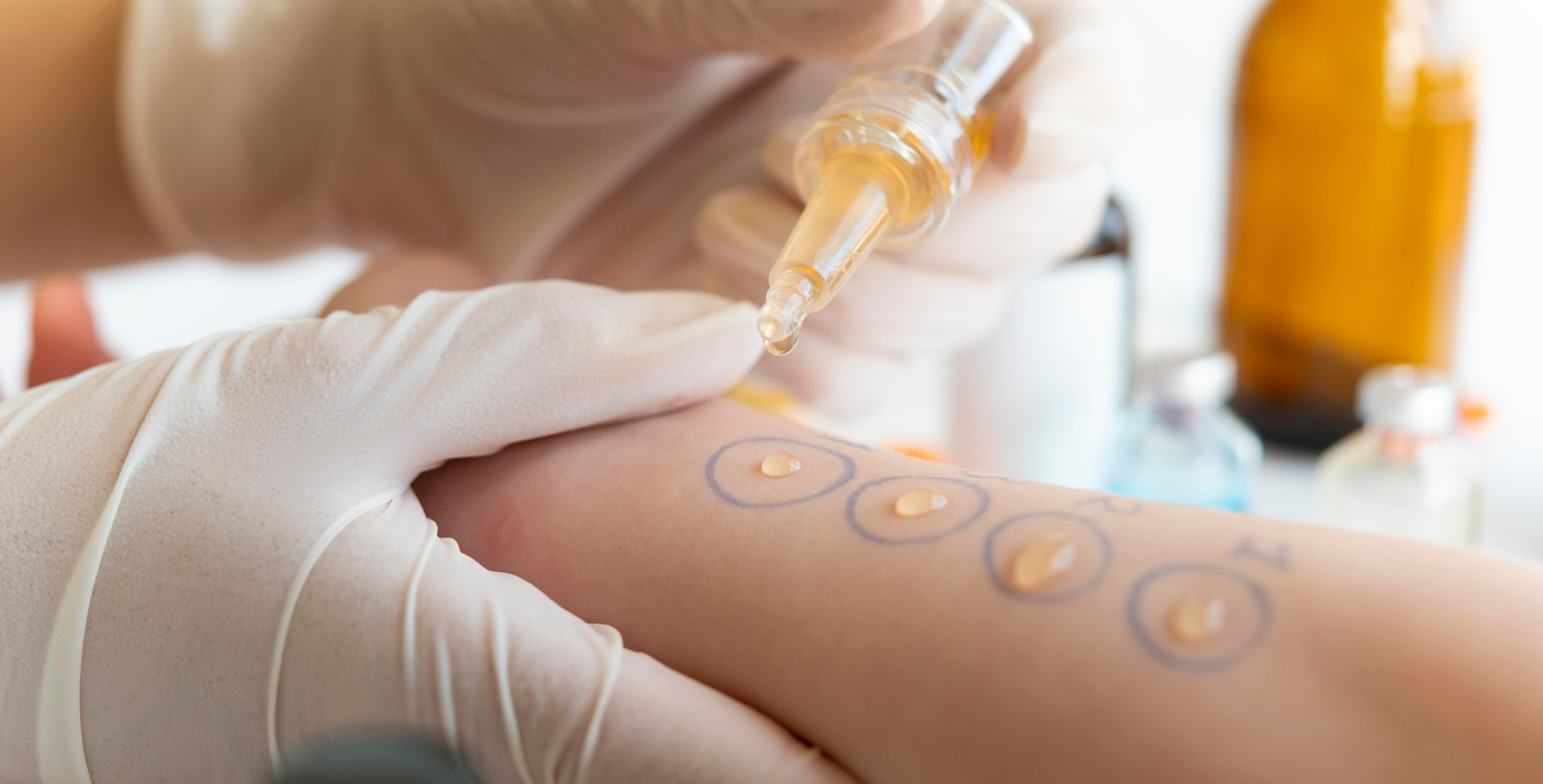 Lipidomics_psoroasis_1000x500.jpg