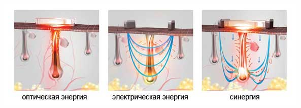 Воздействие элос эпилятора на фолликул волоса