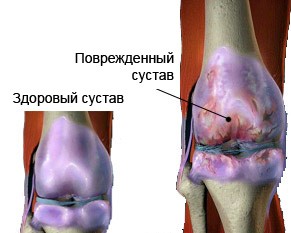 1307747878_osteoartroz.jpg