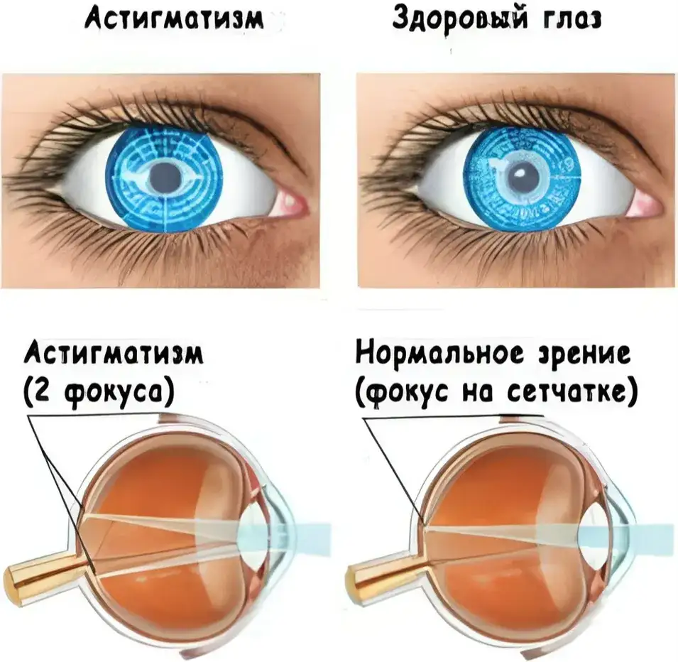 Упражнения для глаз при астигматизме