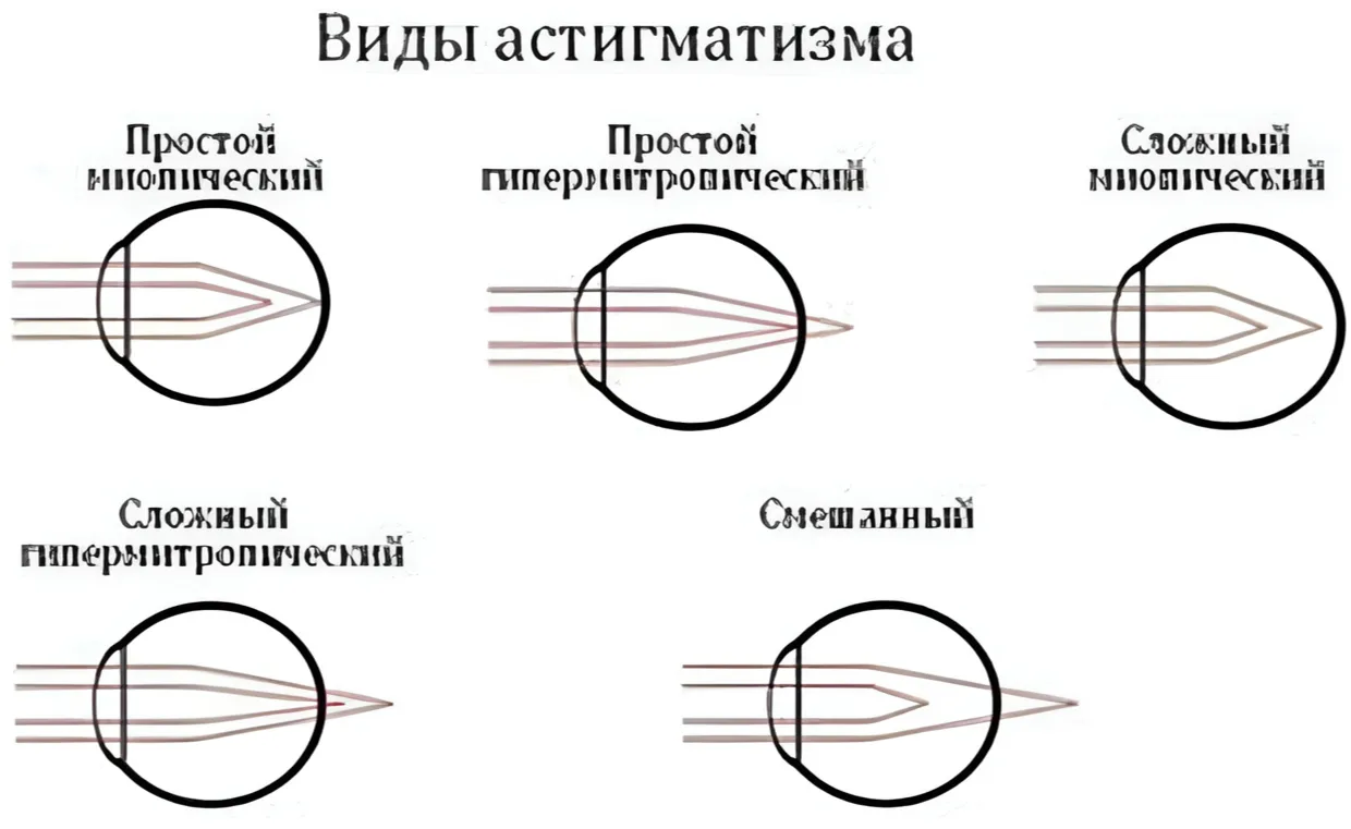 Виды астигматизма