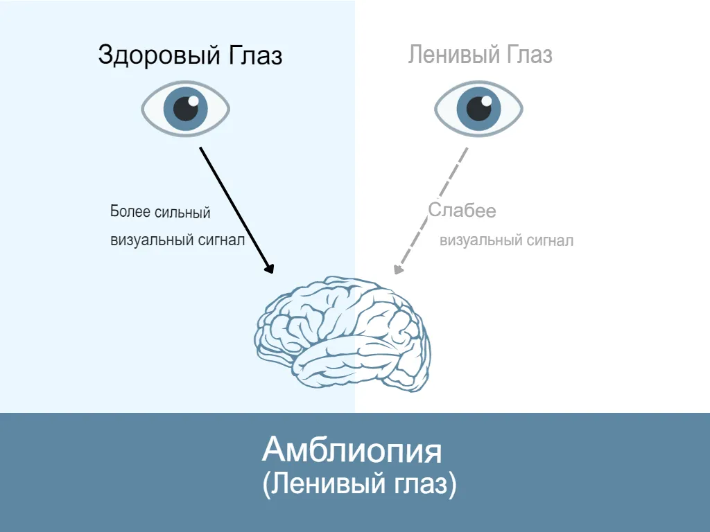 Причины амблиопии