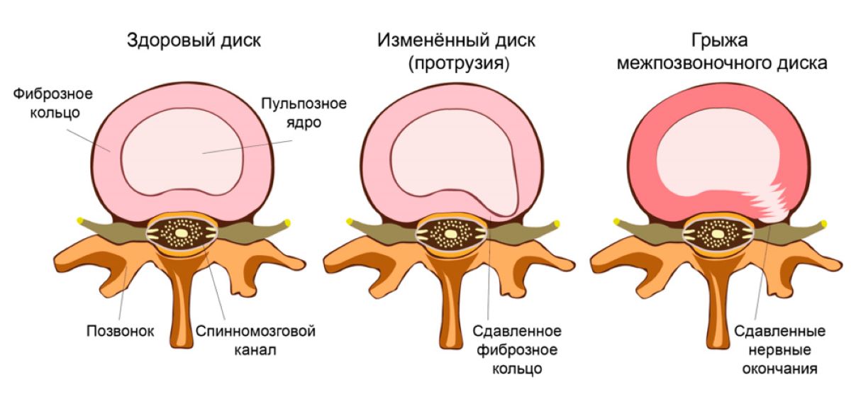 Межпозвоночная грыжа где находится картинки