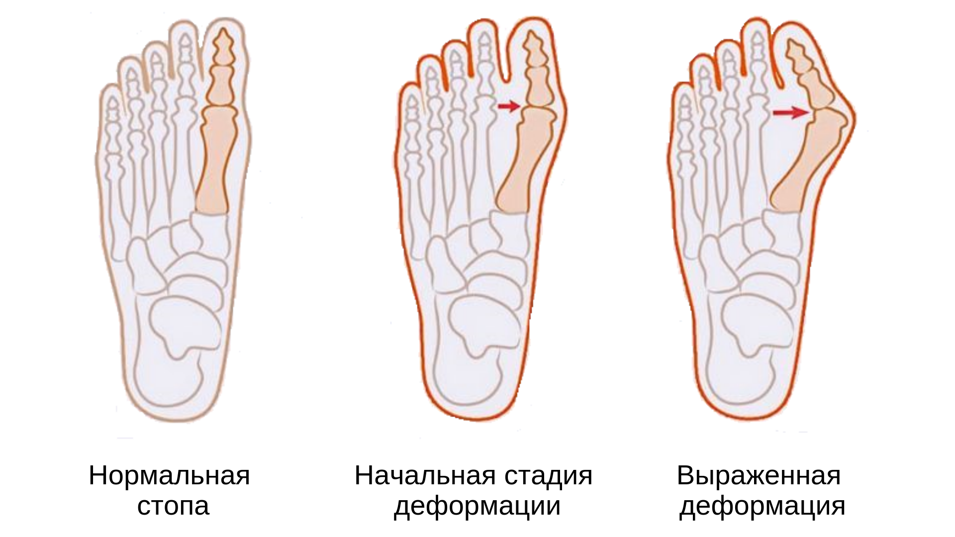 Косточка на большом пальце ноги - лечение и удаление косточек на ногах в клинике СОЮЗ.
