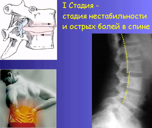 ☰ Лечение остеохондроза поясничного отдела ᐉ Диагностика