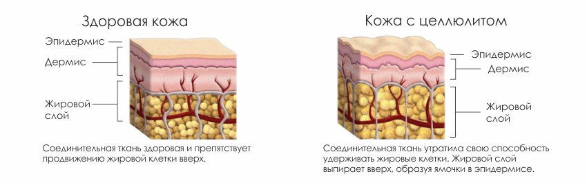 процесс_возникновения_целлюлита.png