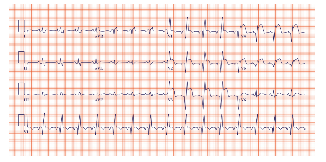 EKG-pri-infarkte