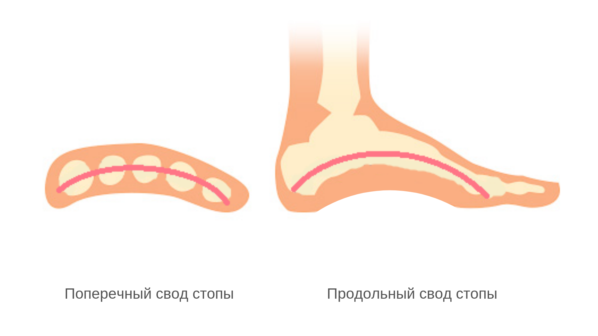 Плоскостопие: лечить, нельзя откладывать