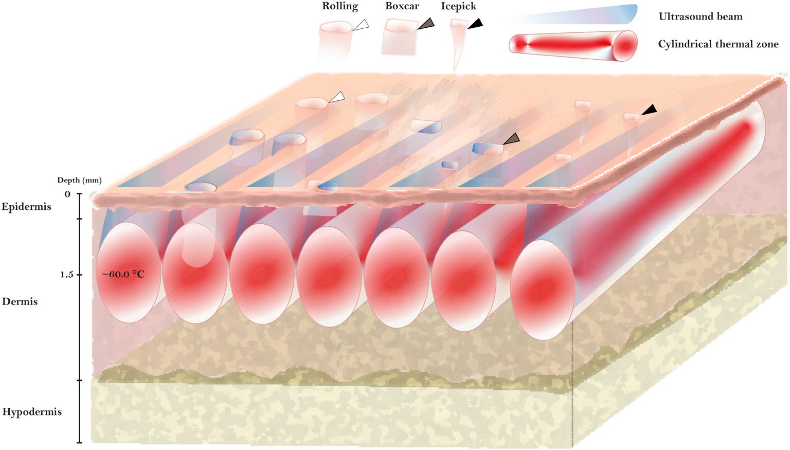 US Parallel for Acne scars_FIG.jpeg