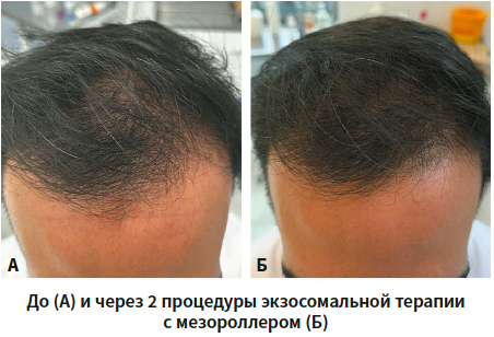Самоделкина (экзосомы) КМ 1-2025_Рис 2.png