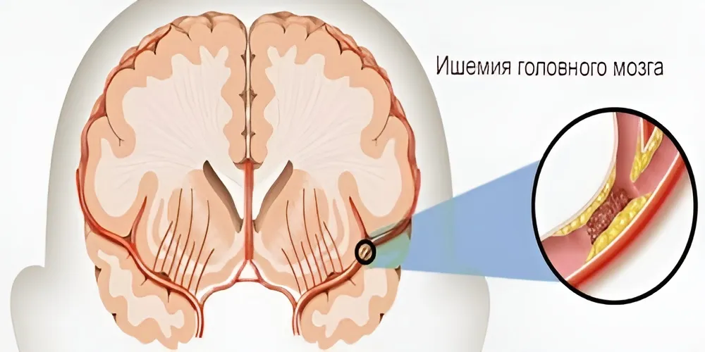 Течение заболевания