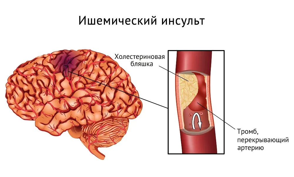 Инсульт