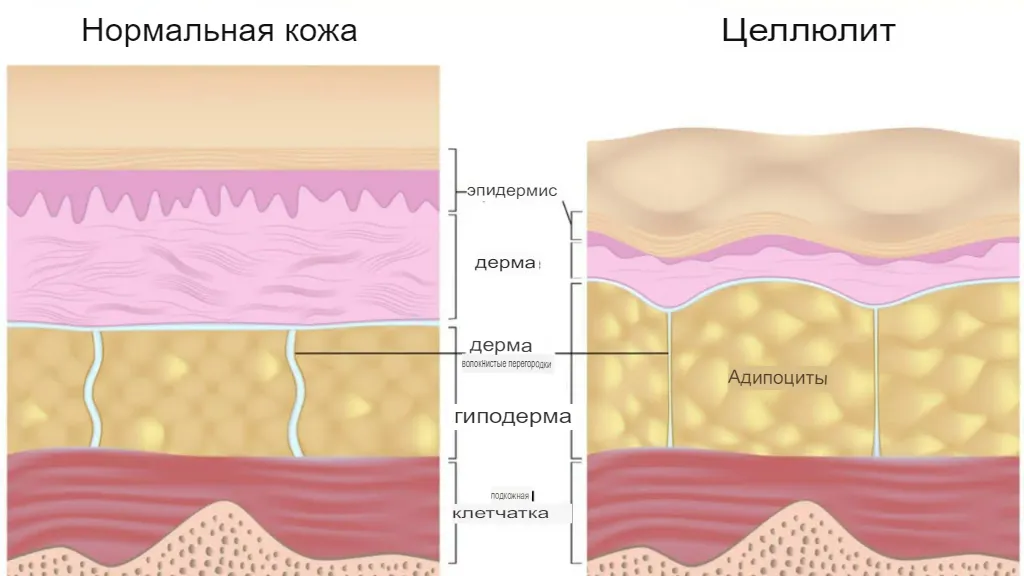 Стадии целлюлита и как с ним бороться