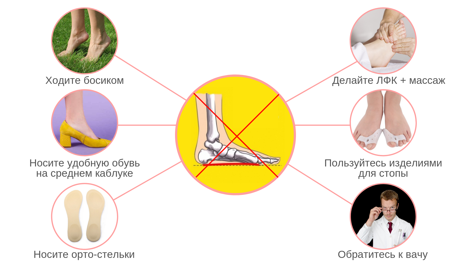 Плоскостопие может быть предотвращено. Плоскостопие. стадии развития плоскостопия. причины возникновения плоскостопия. избыточный вес и плоскостопие.