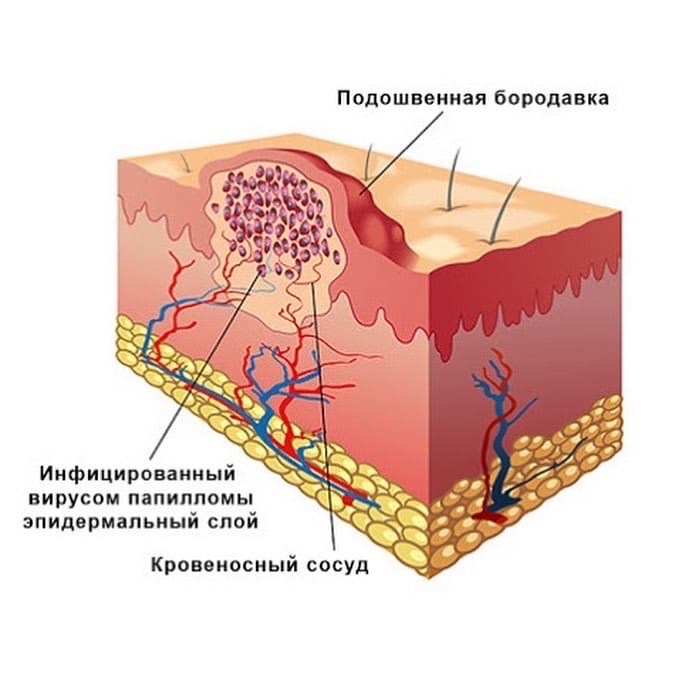 Удаление папиллом на половом члене