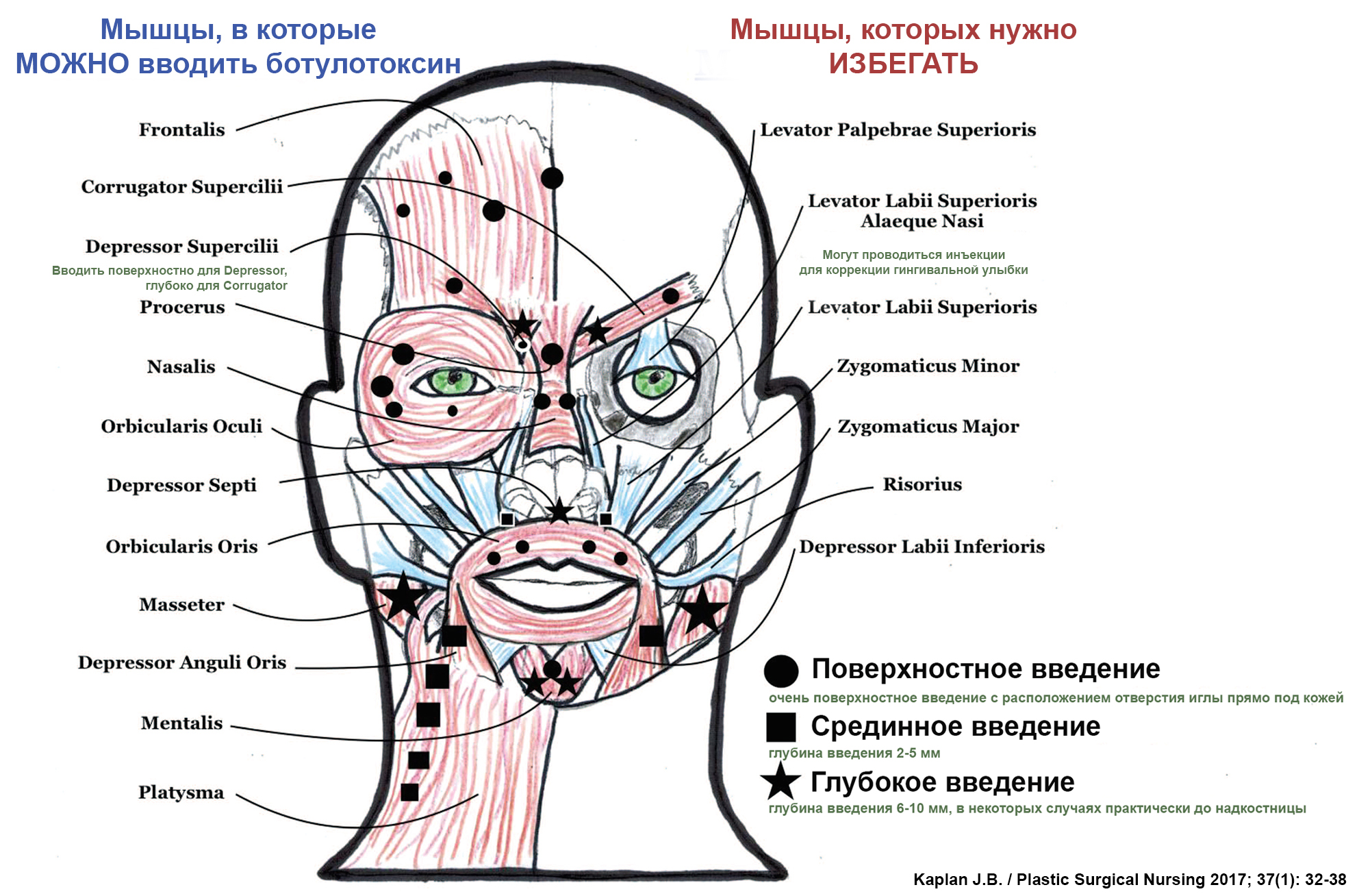 Схема уколов ботокса на лице при носогубных складках