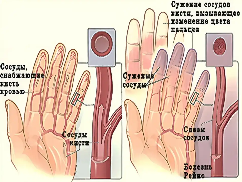 Синдром рейно 3