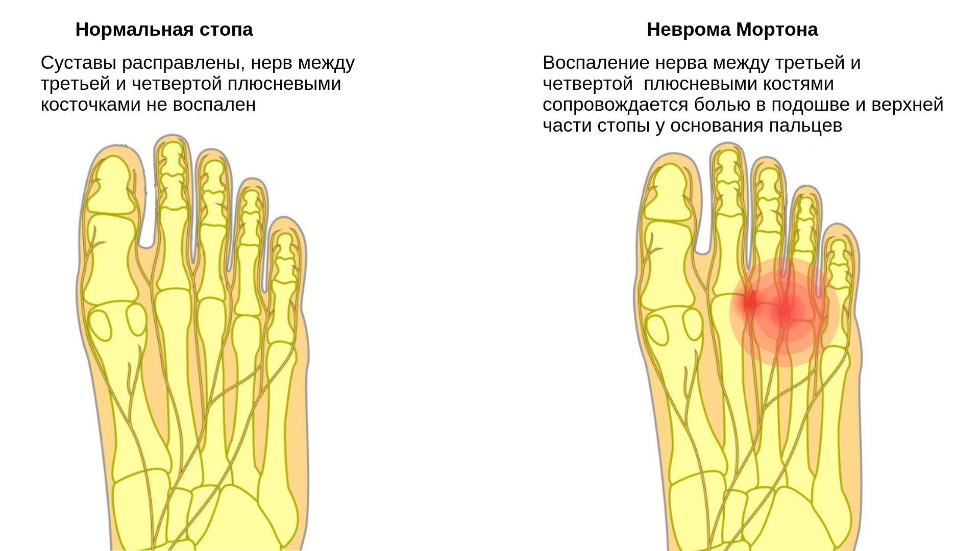 Боли возле пальцев ног. Синдром Мортона неврома.