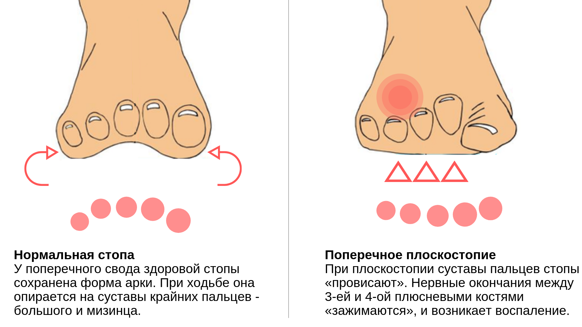 Болит свод стопы причины