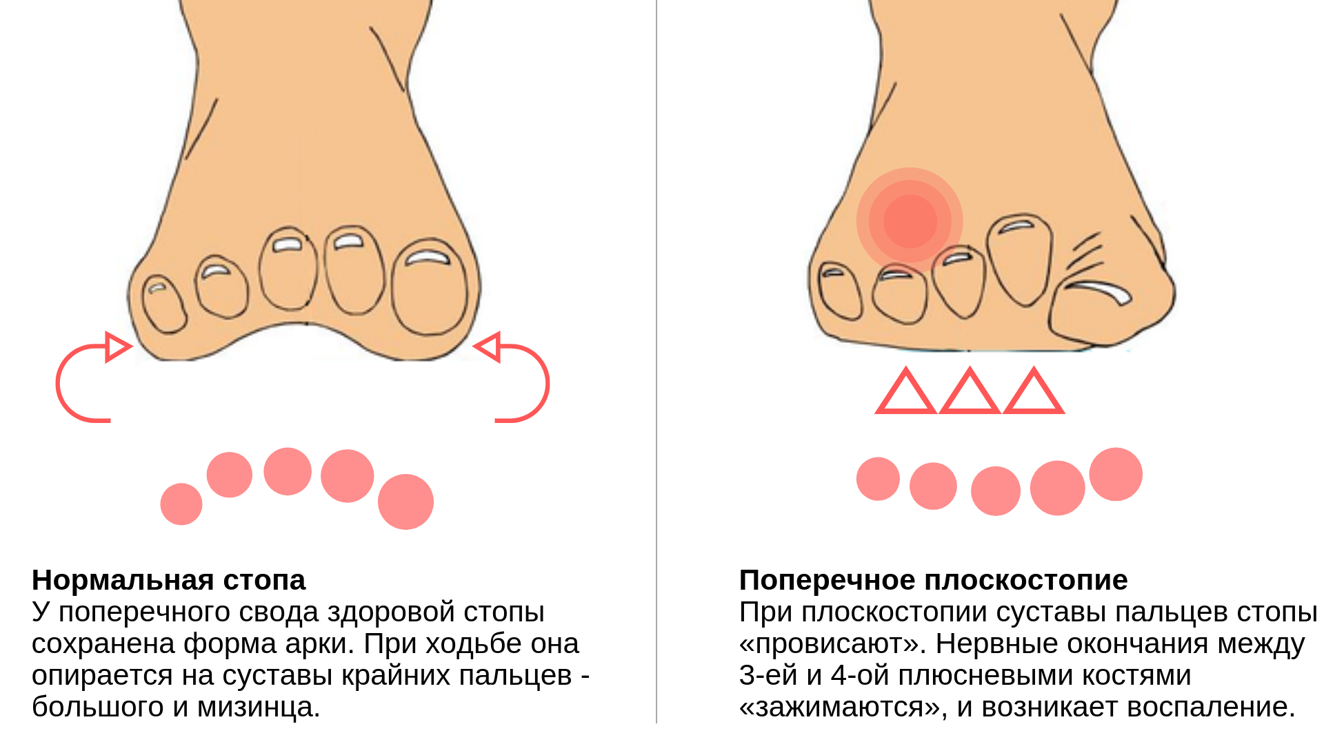 Как лечить народными средствами шишки на ноге возле большого пальца