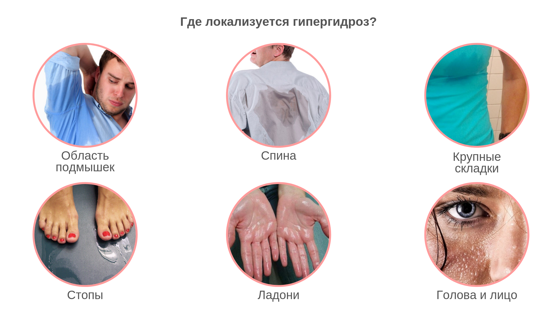 Лечение гипергидроза 【потливости】 подмышек и ладоней Диспортом в Минске