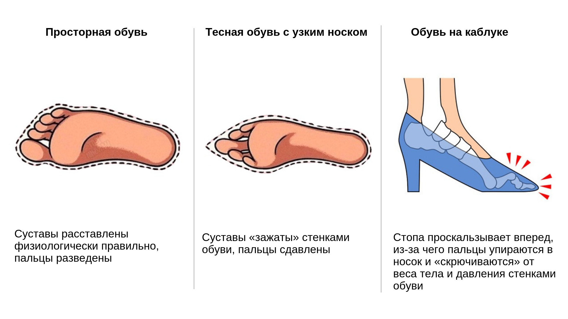 Деформация ног от узкой обуви