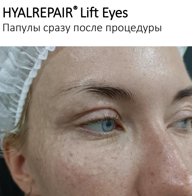 Hyalrepair Lift Eyes